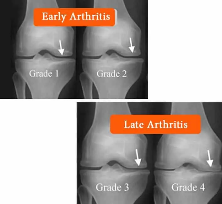 Everything you need to know about getting Arthritis treatment