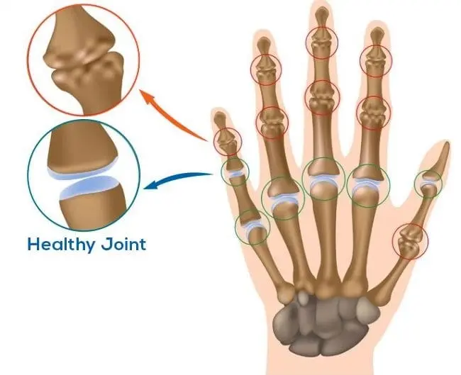 Laboratory Tests for Arthritis Treatment at Hunjan Hospital