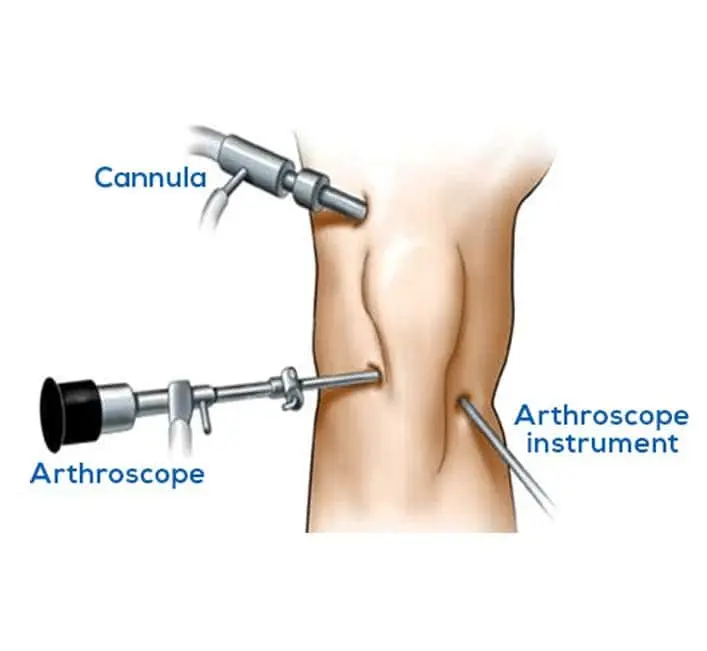 What Is Arthroscopy?