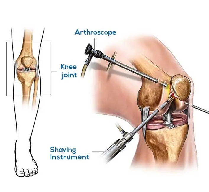 Arthroscopy Surgery benefits and treatment overview