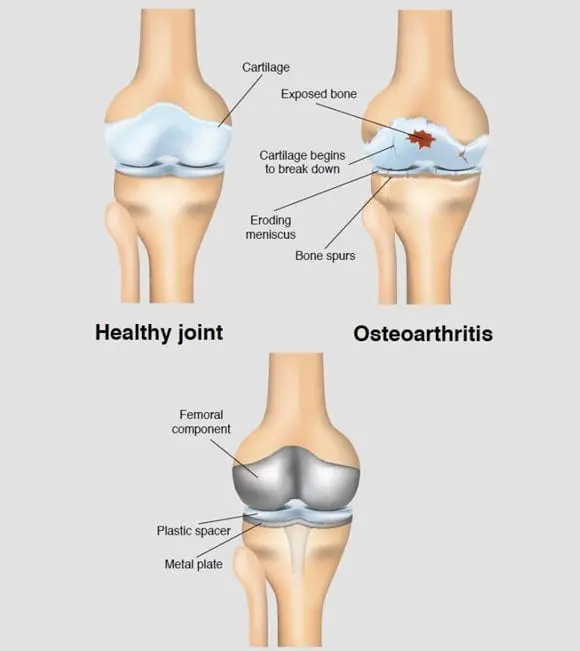 Precautionary Measures to Check Joint Problems