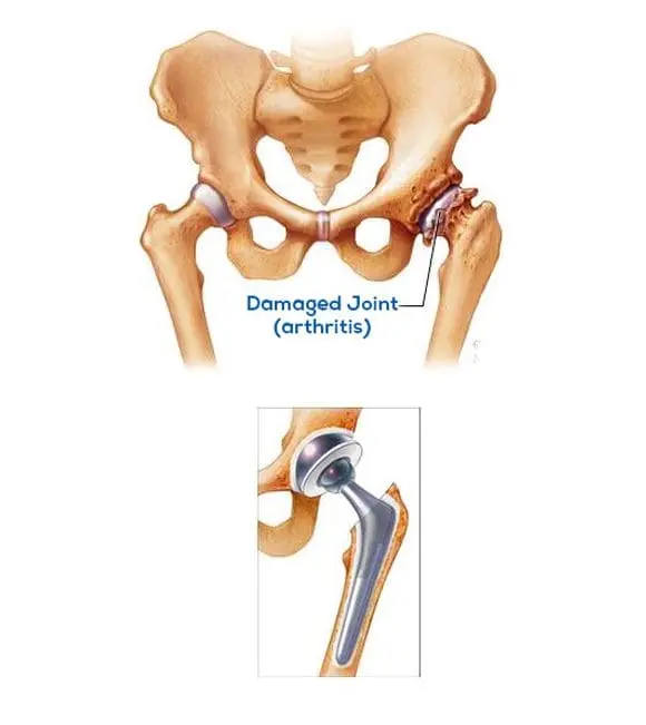 Overview of Hip Replacement Surgery