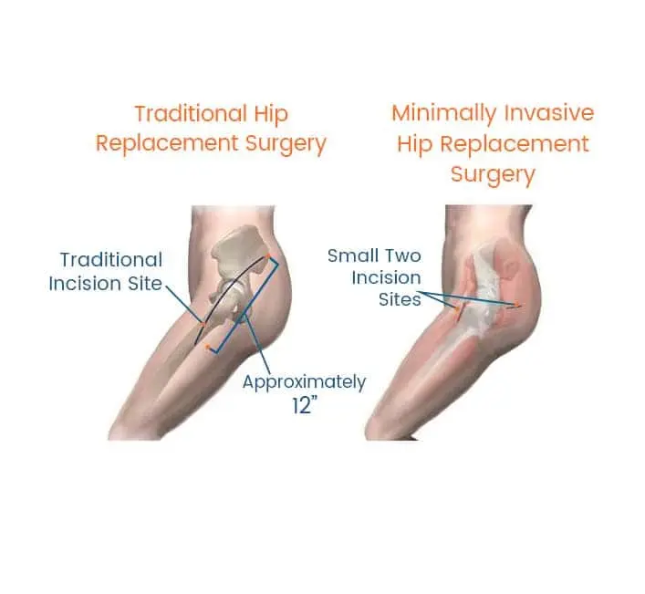 Hip Replacement Surgery benefits and treatment overview