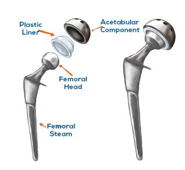 Types of Joint Replacement Surgery Offered at Hunjan Hospital Ludhiana