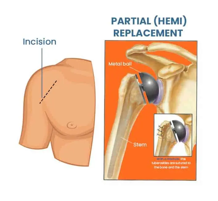 Total vs. Reverse Shoulder Replacement at Hunjan Hospital Ludhiana