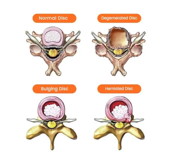 Understanding a Slip Disc at Hunjan Hospital Ludhiana