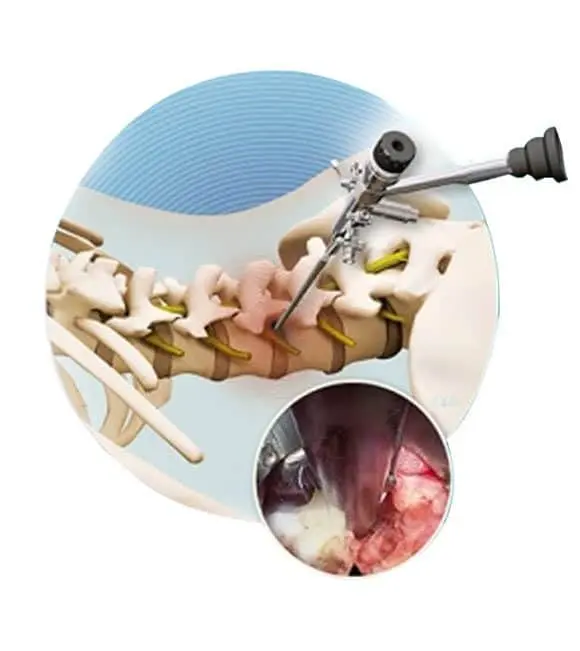 How Endoscopic Spine Surgery is Performed for Spine Surgery at Hunjan Hospital
