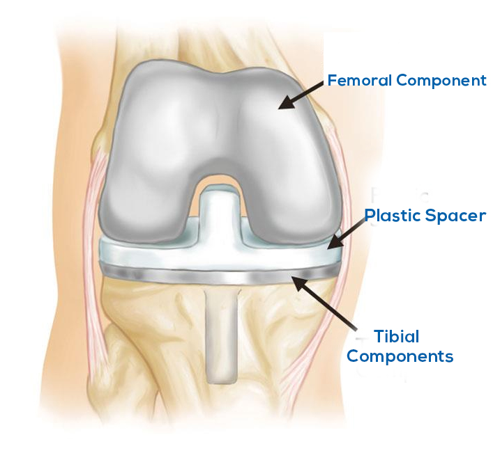 Procedures For Knee Replacement